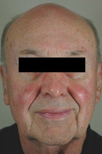 Pulsed Dye Laser Treatment for Rosacea 