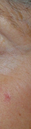 Spider hemangioma (blood freckle) laser treatments