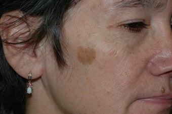 Sunspot removal with IPL
