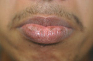 Brown Spots on the Lips