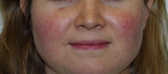 IPL Treatments