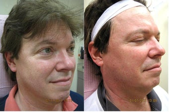 Intense pulsed light (IPL)