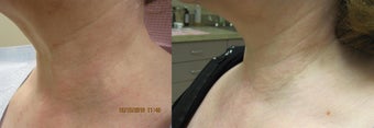 Intense pulsed light (IPL)