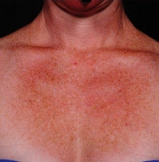 IPL for Chest