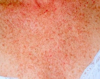 IPL Treatment for Chest
