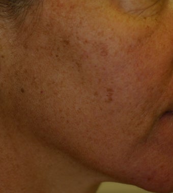 IPL for the face