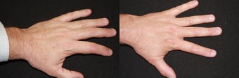 Photorejuvenation