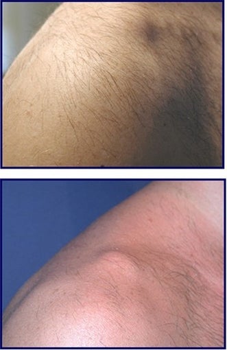 IPL for Age Spot and Hair Removal Before and After