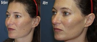  IPL for Age Spots