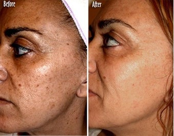  IPL for Age Spots and Freckles