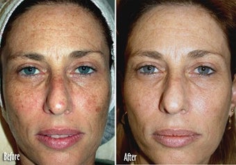  IPL for Freckles, Melasma