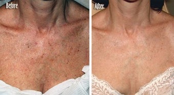 IPL for Freckles, Age Spots on Chest