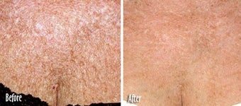  IPL for Age Spots and Uneven Skin Tone on Chest