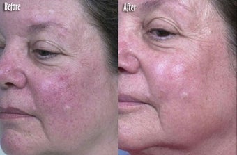  IPL for Spider Veins and Uneven Skin Texture
