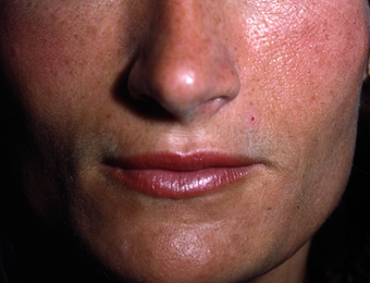 Facial Volumizing with Fillers