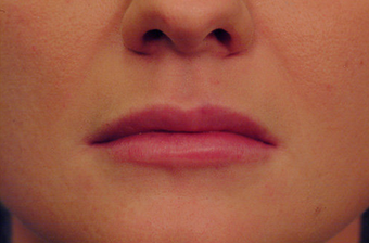 Injectable Filler
