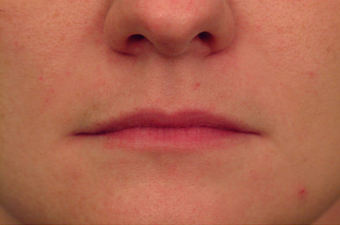 Injectable Filler