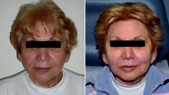 Panfacial Filler