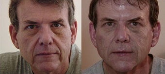 Dermal filler facial transformation