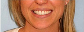 Invisalign