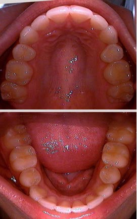 Invisalign