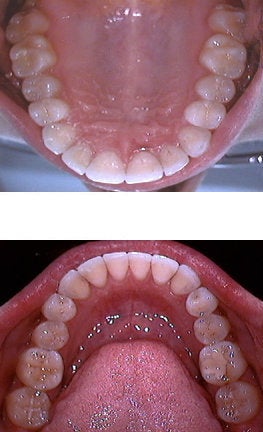 Invisalign