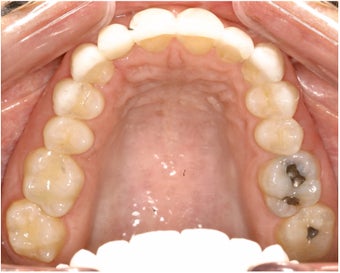 Pre Prosthetic Invisalign