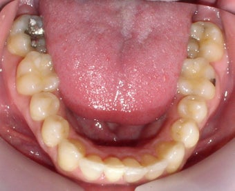 Invisalign
