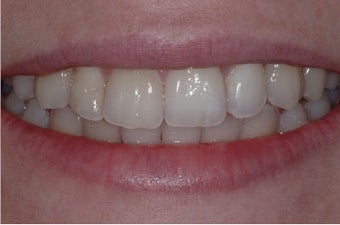 INVISALIGN