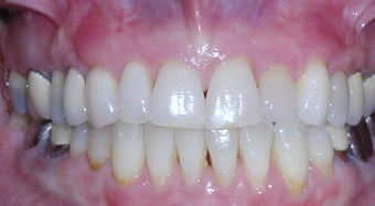 Invisalign correction of crowding