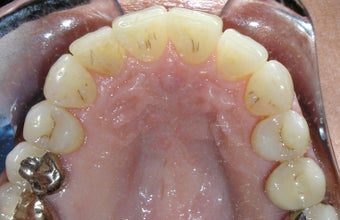 Invisalign: dramatic rotation of front teeth