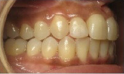Invisalign Treatment