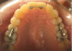 Invisalign Treatment