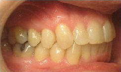 Invisalign Treatment