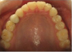 Invisalign Treatment