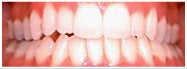 Invisalign to fix Crowded Teeth