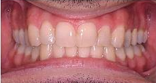 Invisalign