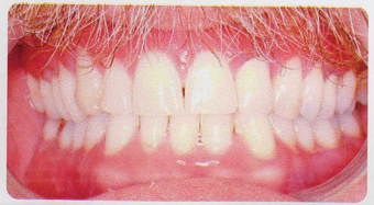 Low incisor extraction