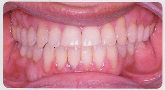 Anterior Crossbite
