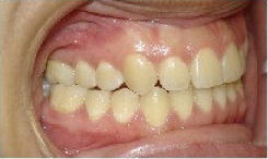 Invisalign Treatment