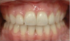Invisalign Treatment
