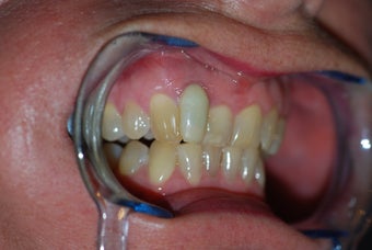 Invisalign to replace a HIDEOUS crown/tooth
