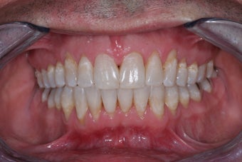 Invisalign 