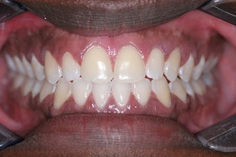 Invisalign