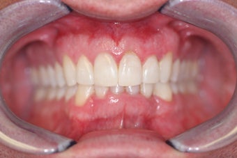 Invisalign