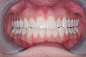 Invisalign