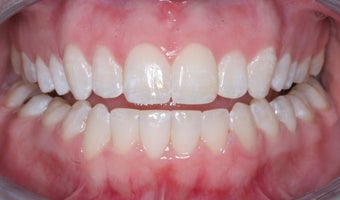 Invisalign