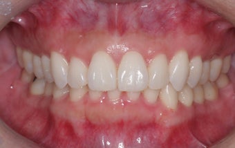 Invisalign