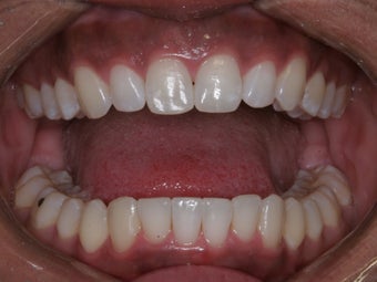 Invisalign