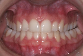 Invisalign